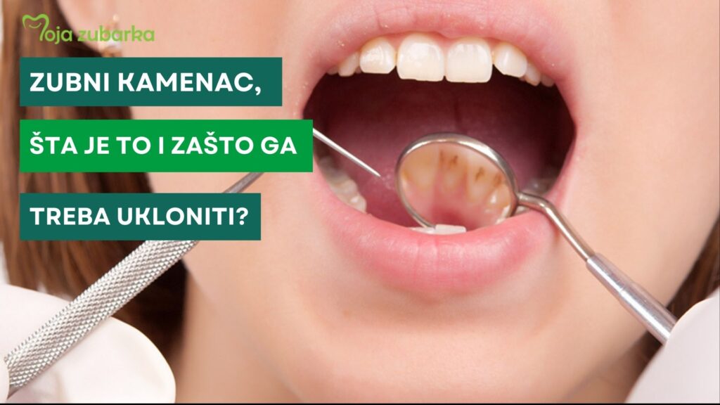 Zubni kamenac, šta je to i zašto ga treba ukloniti? • Moja Zubarka